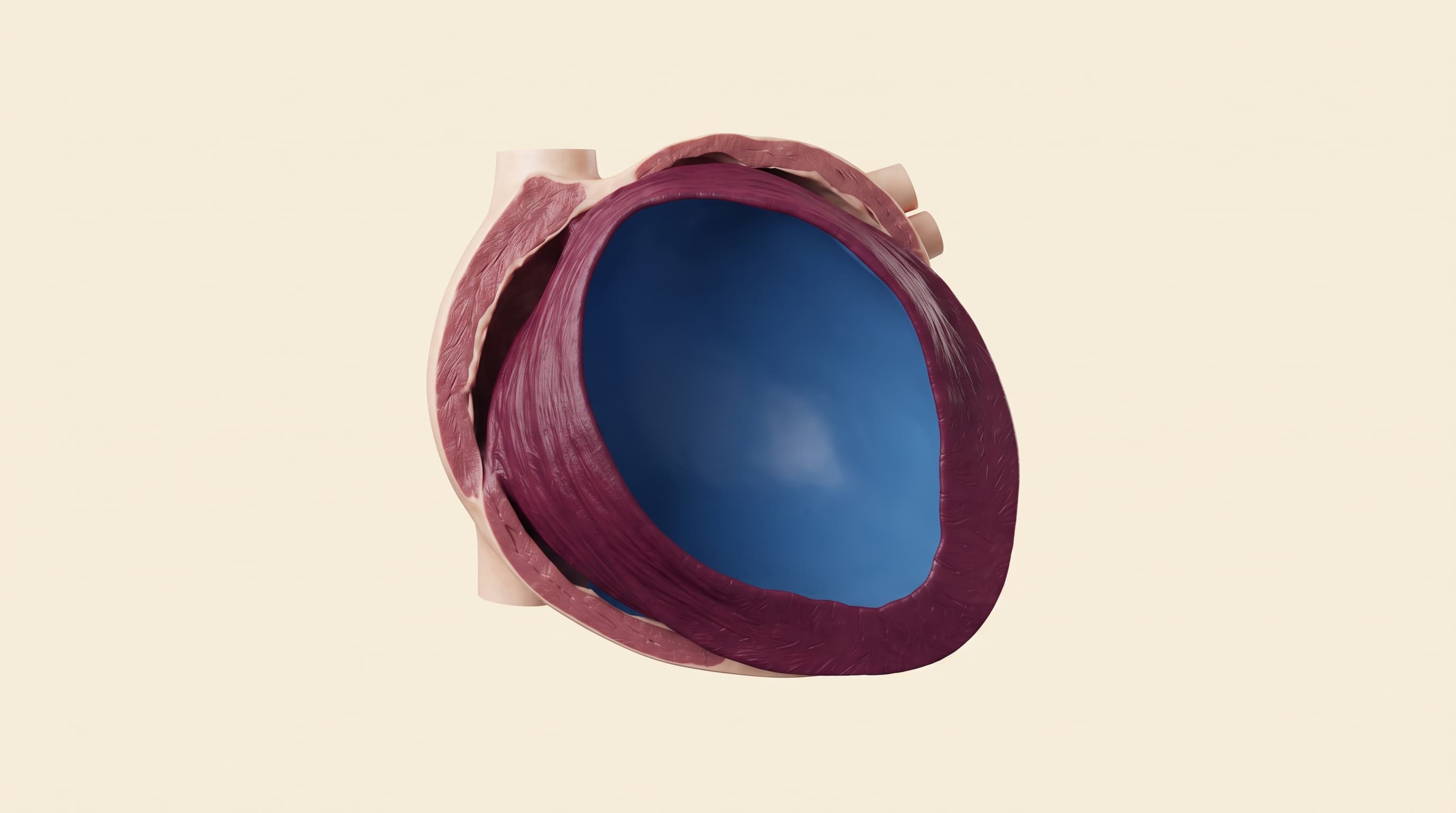 Cardiomiopatía dilatada