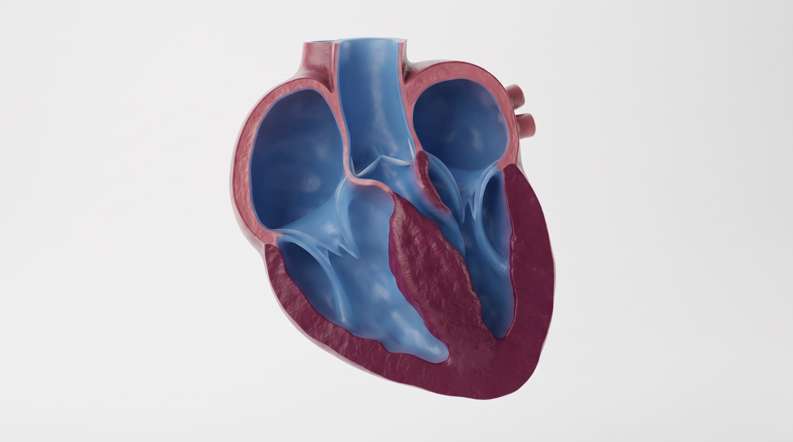 Cardiomiopatía hipertrófica (CMH)