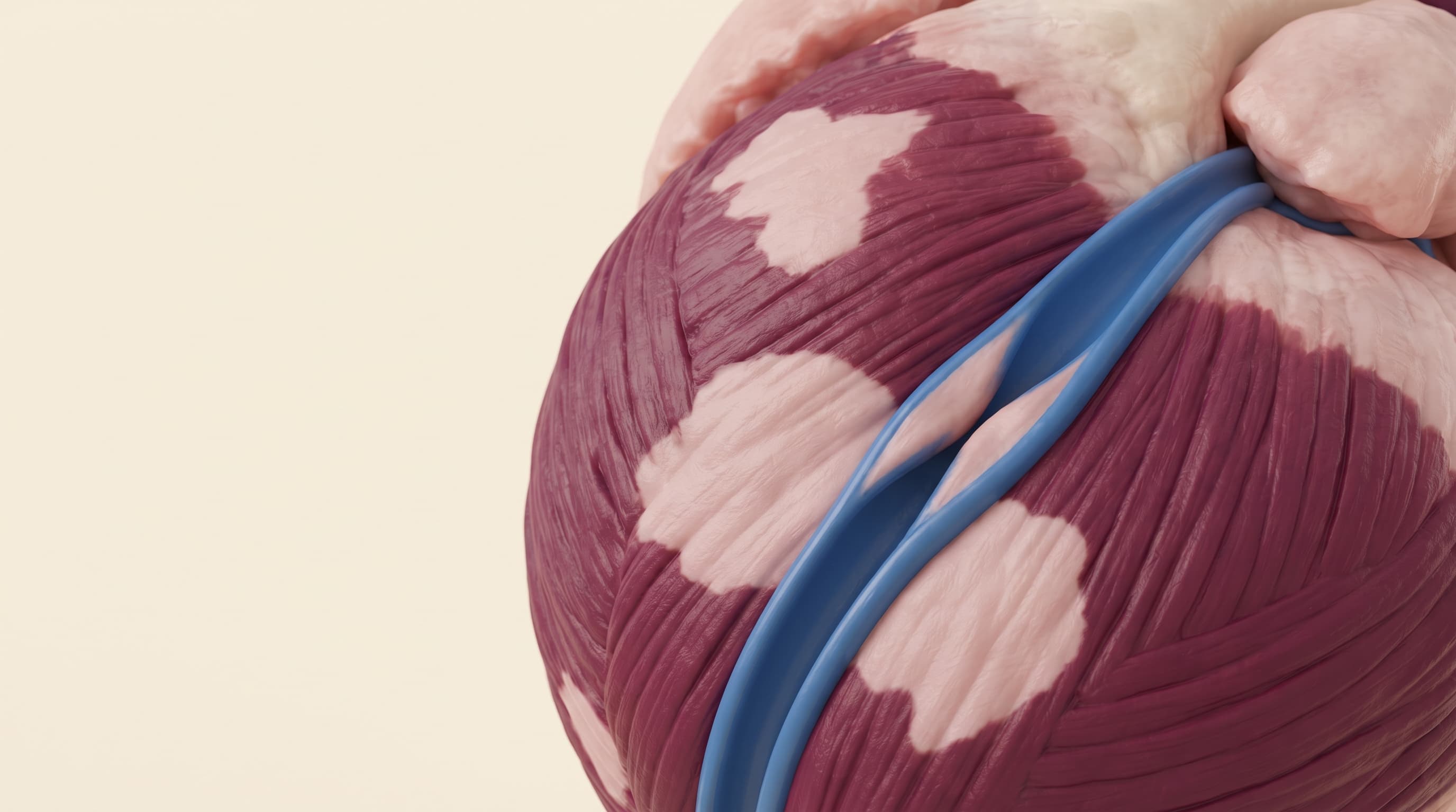 Cardiomiopatía isquémica